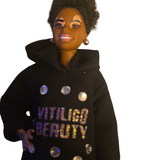 Barbie - Vitiligo Beauty